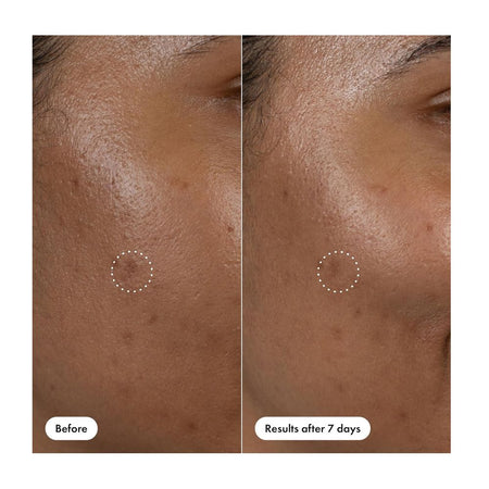 Hero Cosmetics Dark Spot Correct Spot-Fading Serum, Vitamin C, Hyaluronic Acid, For Acne-Prone Skin, 10ml - Image 7