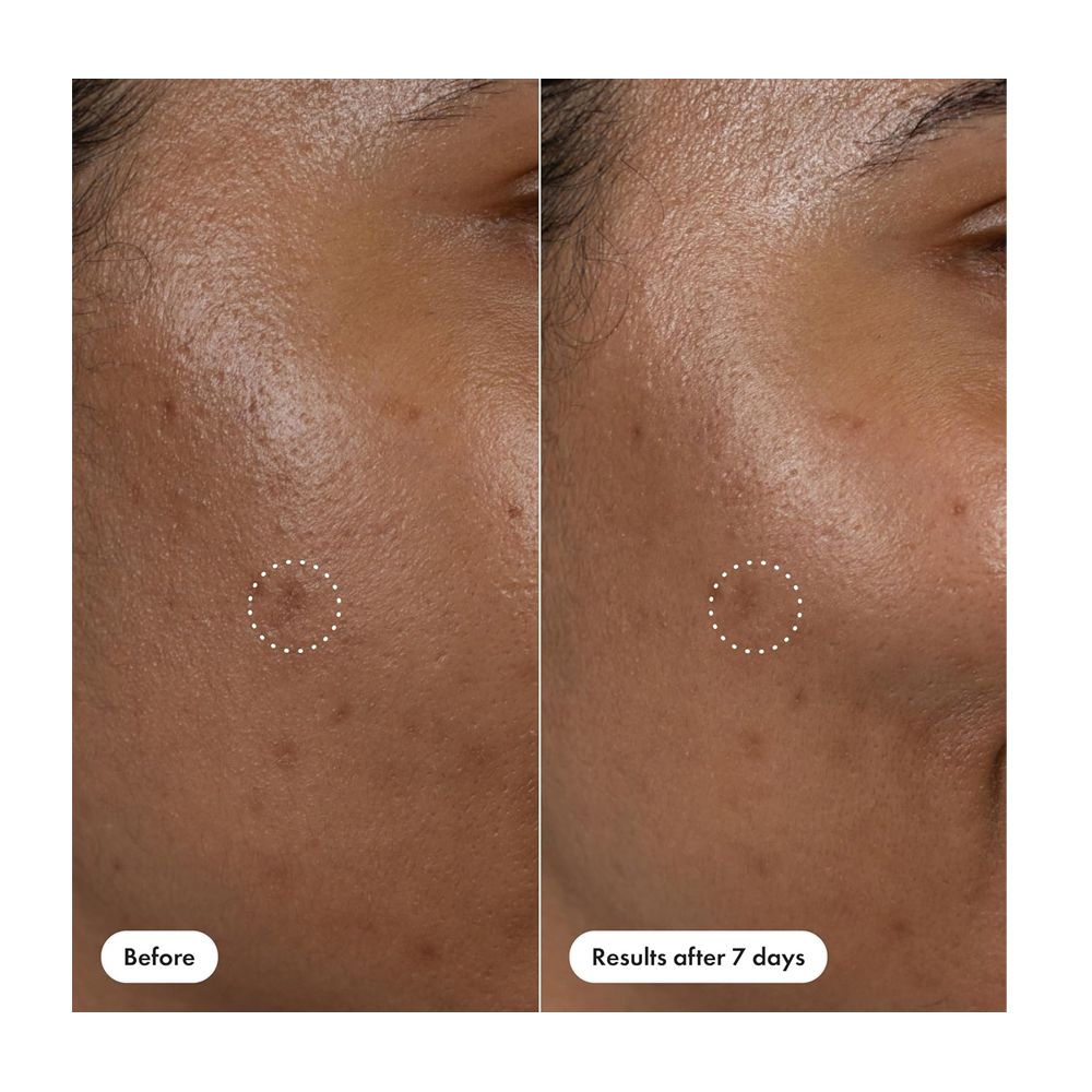 Hero Cosmetics Dark Spot Correct Spot-Fading Serum, Vitamin C, Hyaluronic Acid, For Acne-Prone Skin, 10ml - Image 7