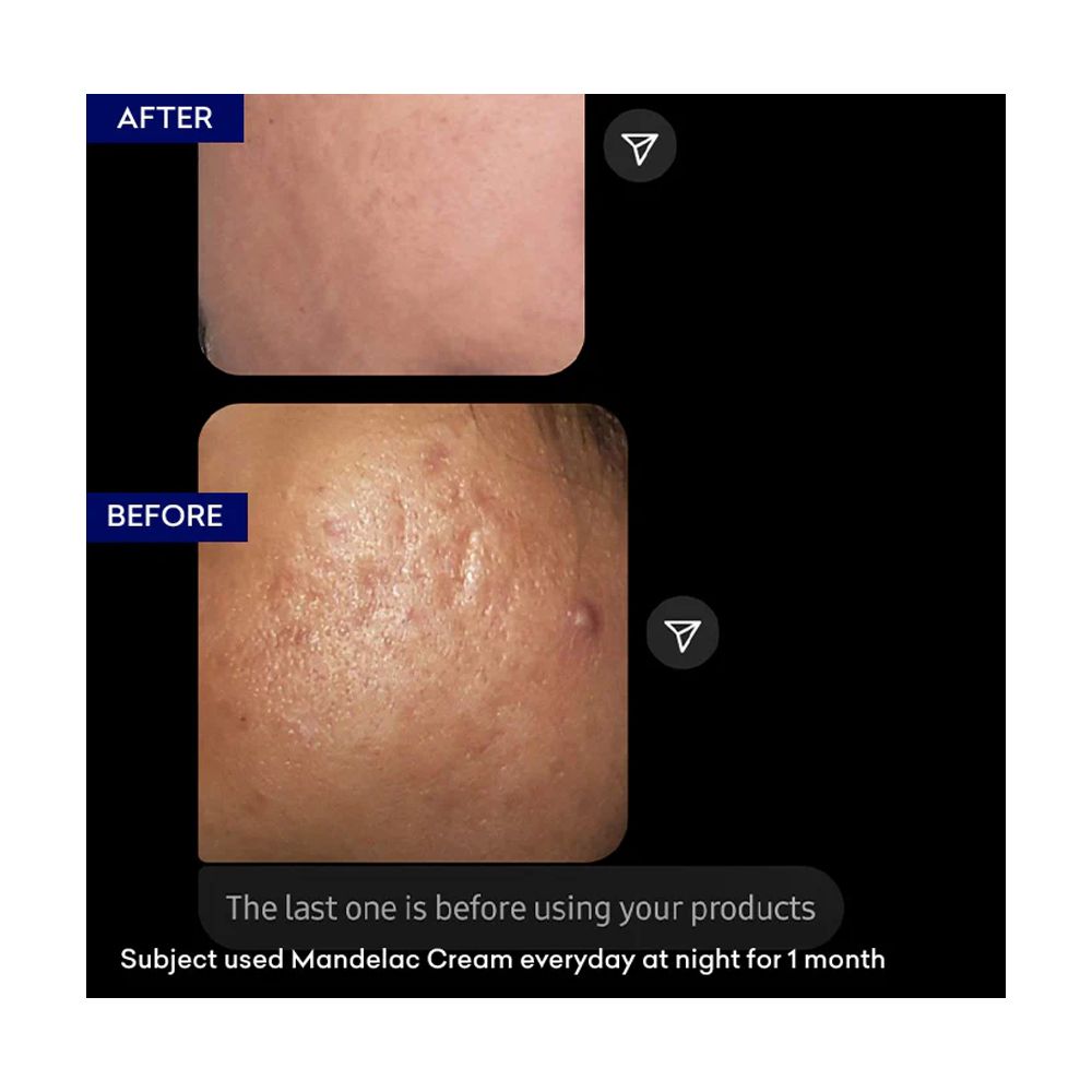 Jenpharm 10% Mandelac Exfoliating Night Cream, Reduces Acne & Acne Marks, 30g - Image 6