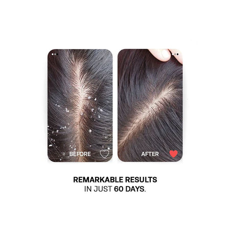 Treatments Anti-Dandruff Rescue Shampoo, Salicylic Acid, Glycolic Acid & Vitamin B5, For Dandruff, 250ml - Image 4