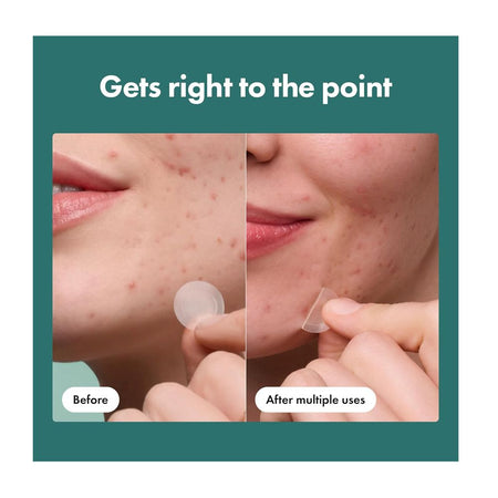 Hero Cosmetics Micropoint Pimple Patch, Salicylic Acid, Cica, For Acne-Prone Skin, 8-Pack - Image 6