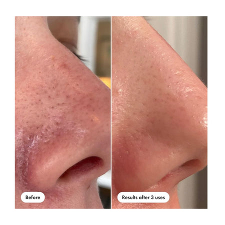 Hero Cosmetics Pore Release Blackhead Clearing Solution, Salicylic Acid, AHA & BHA, For Oily & Sensitive, 100ml - Image 5