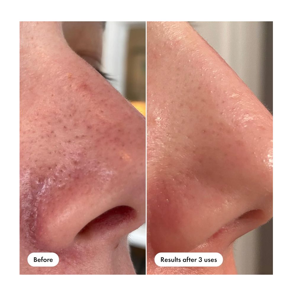 Hero Cosmetics Pore Release Blackhead Clearing Solution, Salicylic Acid, AHA & BHA, For Oily & Sensitive, 100ml - Image 5