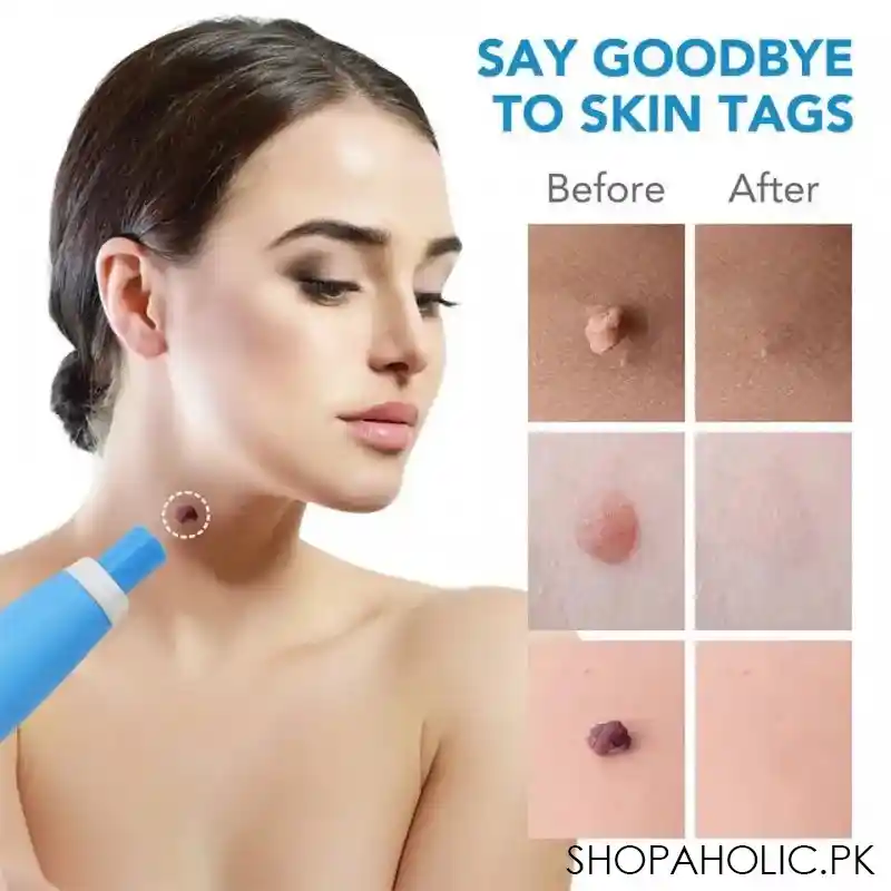 skin tag remover image2