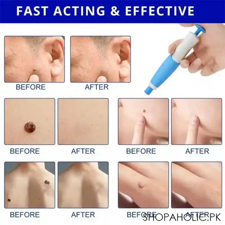 skin tag remover image3