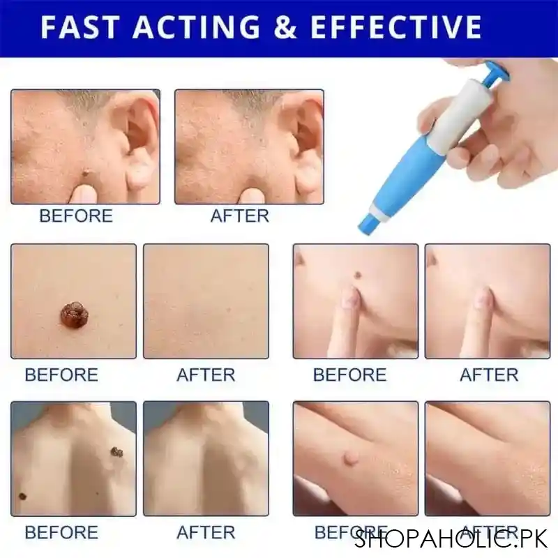 skin tag remover image3